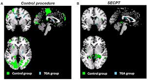 Image result for Transient Global Amnesia