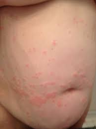 chronic spontaneous urticaria you may not be familiar with the name but you may recognise the red urticaria chronic spontaneous urticaria chronic hives