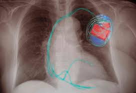 Medical education pacemaker, icd, and crt overview. Implantable Cardioverter Defibrillator Complications