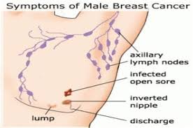 Most oropharyngeal cancer is of the squamous cell. What Are The Signs And Symptoms Of Male Breast Cancer Signs And Symptoms Of Cancer Symptoms And Signs Of Breast Because Of This Many Men Tend To Ignore Its