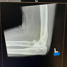 Image result for Elbow XRay