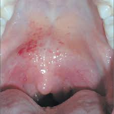 It will also give a brief description of the type of bump combined with medical. Throat Pain And Red Spots On Palate Mdedge Family Medicine