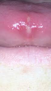 Image result for Puchýře na jazyku