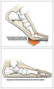 Knee extension is vital, but knee flexion is a close runner up! Orthotic Management Tactics For Hallux Limitus Lower Extremity Review Magazine