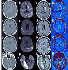 Abbreviation for bank board bureau. The Application Of Mri For Depiction Of Subtle Blood Brain Barrier Disruption In Stroke