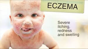 For baby's skin & hair · with natural ingredients Eczema In Babies Effective Treatment Of Dry Skin Conditions