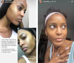Ciara Miller Shares Skin Transformation Before & After Photos