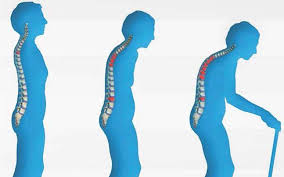 Some guidelines also recommend screening men by age 70, especially if they have health issues likely to cause osteoporosis. Osteoporosis Breaks Your Bones Here S A Low Down On The Silent Disease Supplements News Issue Date Feb 22 2016
