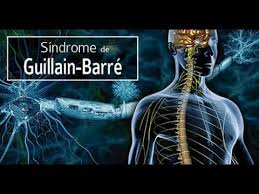 Por lo general, ocurren en ambos lados del cuerpo. Sindrome De Guillan Barre Terapia Fisica Youtube