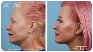 While you may not notice it initially, it can eventually impact your vision. Charlotte Age 51 Female Facelift Neck Lift And Facial Fat Grafting Case 1113 Before After Plastic Surgery Charlotte Plastic Cosmetic Surgeon Aesthetic Surgery Of Charlotte