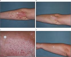 Image result for Calcipotriene