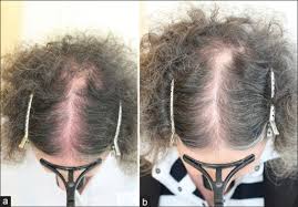 An embarrassment which is common to many an adult and sunburn which leads to the production of dead cells caused due to the burning of the superficial neurogenic excocriation is a condition of itching in the scalp, thinning and loss of the hair due to. A And B Red Scalp Syndrome Before And After 6 Months Open I