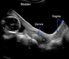 Normal 2nd Trimester Ultrasound How To Medical Ultrasound Ultrasound Technician Diagnostic Medical Sonography