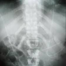 Post Operative Abdominal X Ray After Distal Catheter Trimming Download Scientific Diagram