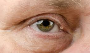 Die gerstenkornmusterung, insbesondere zur verbesserung der eigenschaften von handtüchern. Hagelkorn Am Auge Was Tun Netdoktor At