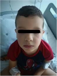 Remember bradykinin-induced angioedema — an unforgettable image