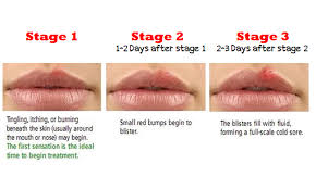 After the first episode, the virus can become latent and remain in sensory nerves. Amazon Com Erase Herpes Appstore For Android