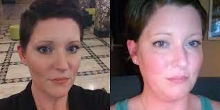 9 Side Effects Of Prednisone I Ve Experienced Prednisone Side Effects Prednisone Side Effects