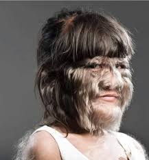 Image result for Hypertrichosis