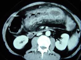 Image result for Neutropenic Colitis