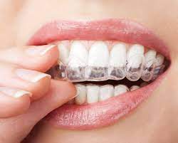 Four Fantastic Facts About Retainers