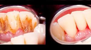 Tomato spit the waste particles and rinse off the mouth. 4 Mixtures That Completely Remove Plaque From Your Teeth