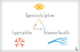 Image result for Hyperviscosity Syndrome