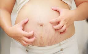 Rinse off with cool water. Pregnancy Rash What Is Puppps Parents
