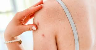 Image result for Papule