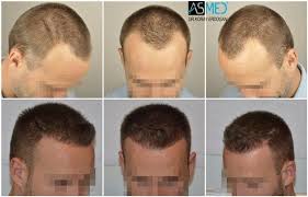 Asmed Koray Erdogan 3005 Grafts Fue Istanbul Turkey Hairtransplant Hairtransplantistanbul Hairt Hair Transplant Hair Transplant Uk Hair Transplant Results