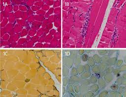 Let's take a look at some practical ideas of using can lights in different rooms, maybe they will help you. Cureus Autoantibody Negative Immune Mediated Necrotizing Myopathy Responds To Early And Aggressive Treatment A Case Report