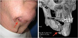 Image result for Osteomyelitis