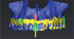 Dental Update - Predictability in anterior aesthetic implants: assessment,  planning and execution