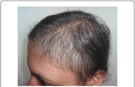There hasn't been a new hair loss drug approved in twenty years. Right Temporal View Monilethrix New Hair Growth Retained With Less Download Scientific Diagram
