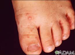 Image result for Hand foot and mouth disease HFMD roof of mouth