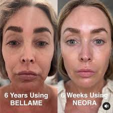 Neora's plant-based skincare system results