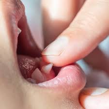 Image result for Alveolitis sicca)