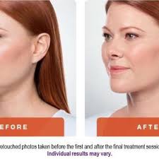 TOP 10 BEST Prp Microneedling in Athens, GA