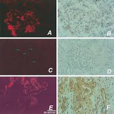 Cardiac amyloid deposition, causing an infiltrative/restrictive cardiomyopathy, is a frequent feature of amyloidosis10. Pdf Diagnosis Of Renal Amyloidosis Using Congo Red Fluorescence