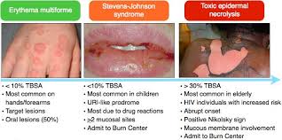 Rosh Review Steven Johnson Syndrome Dermatology Nurse Practitioner Education