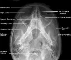 Radiographic Anatomy Of Facial Bones In 2020 Facial Bones Medical Radiography Radiology Student