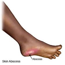Abscess - What You Need To Know