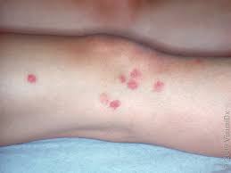 Image result for bedbugs bites