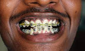 Maybe you would like to learn more about one of these? Cost Of Dental Braces In Nigeria July 2021