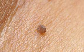 التهديد بند صفق اسباب فيروس hpv عند الرجال dsvdedommel com