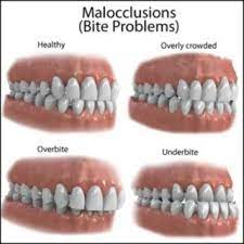 There are a variety of different kinds of crossbites and underbites. Underbite Overbite Dr Arash Dds Underbite Overbite Specialist La