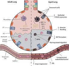 Ards happens when the lungs become severely inflamed from an infection or injury. Frontiers The Impact Of Aging In Acute Respiratory Distress Syndrome A Clinical And Mechanistic Overview Medicine