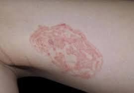 While most antibacterial hand gels are drying to the skin thereby providing a less hospitable. What Is The Best Way To Treat Ringworm On The Skin Quora