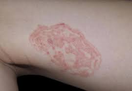 Watch the video to discover the answer to how does hand sanitizer kill germs? and don't forget to vote for next week's question! What Is The Best Way To Treat Ringworm On The Skin Quora