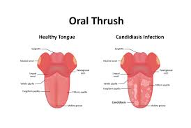 Image result for Oral thrush roof of mouth